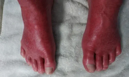 Erythromelalgia Leg Pain Diagnosis And Treatments